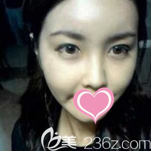 ?到上饒尚美醫(yī)療美容門診部做自體脂肪全面部填充后，才知道脂肪也是可以變“肥”為寶的