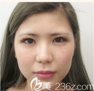 日本口碑很好的老牌整形醫(yī)院有哪些?說說我在十仁美容找鳴海榮治做的切開雙眼皮經(jīng)