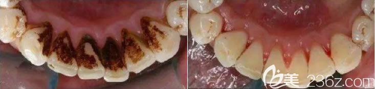 天津美奧口腔陳東來院長洗牙前后對比效果: 天津美奧口腔陳東來院長洗牙前后對比效果: