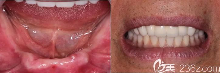 天津美奧口腔譚川云半口種植牙案例對(duì)比圖 天津美奧口腔譚川云半口種植牙案例對(duì)比圖