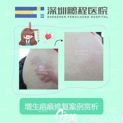 深圳鵬程醫(yī)院疤痕科增生疤痕修復案例