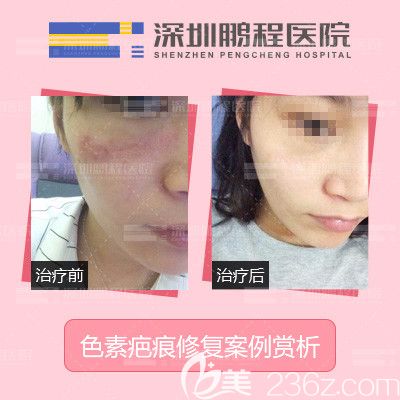 深圳鵬程醫(yī)院像素疤痕修復案例