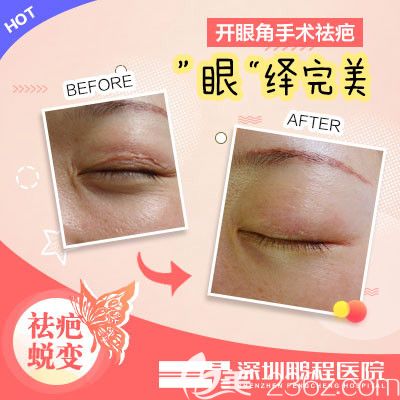 深圳鵬程醫(yī)院呂美琪做的開眼角手術疤痕修復案例