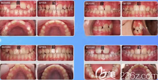 天津美奧口腔王醫(yī)生MRC肌功能矯正案例圖 天津美奧口腔王醫(yī)生MRC肌功能矯正案例圖