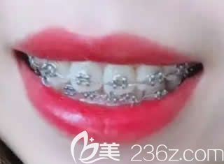 孩子在深圳格倫菲爾口腔做金屬托槽矯正第6個月 孩子在深圳格倫菲爾口腔做金屬托槽矯正第6個月