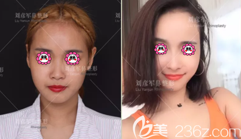 北京沃爾整形醫(yī)院馮雁平肋軟骨鼻綜合整形<span style=