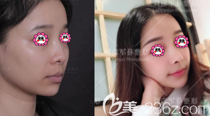 北京沃爾醫(yī)療美容趙丹醫(yī)生硅膠假體隆鼻<span style=