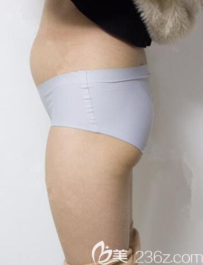 腰腹環(huán)吸前照片 腰腹環(huán)吸前照片