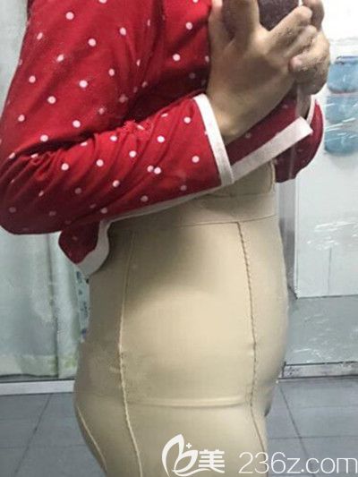 腰腹吸脂第四天 腰腹吸脂第四天