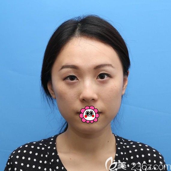 西寧時(shí)光全切雙眼皮術(shù)前 西寧時(shí)光全切雙眼皮術(shù)前