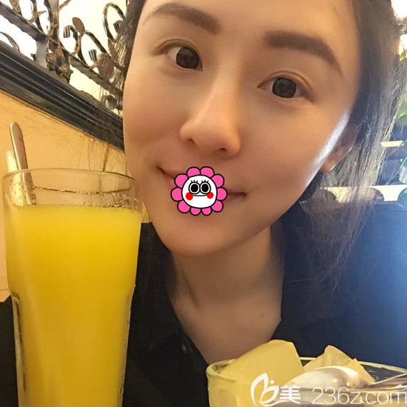 西寧時(shí)光<!--<i data=20240703-sp></i>-->雙眼皮術(shù)后20天 西寧時(shí)光<!--<i data=20240703-sp></i>-->雙眼皮術(shù)后20天