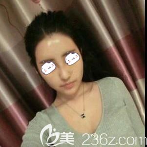 做自體脂肪面部填充術(shù)后10天臉部腫脹消除針孔消失