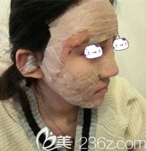 謝靚花主任幫我做自體脂肪面部填充術(shù)后即刻