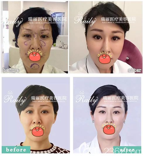 溫州瑞安瑞麗王俞明脂肪填充案例