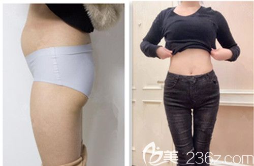 株洲華美年華腰腹吸脂親身經(jīng)歷真實反饋：一個月后貌似有“腰”了，附前后效果對比圖