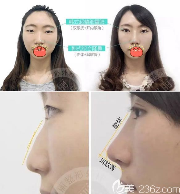 瑞安瑞麗王俞明鼻綜合隆鼻案例