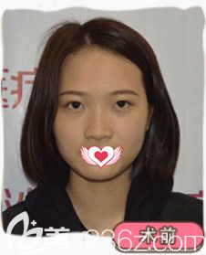 在邢臺(tái)美加美做鼻綜合術(shù)前是塌平的鼻子 在邢臺(tái)美加美做鼻綜合術(shù)前是塌平的鼻子