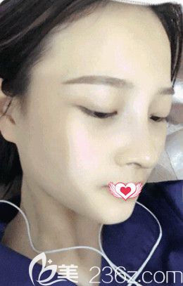 邢臺遇見美韓偉強院長做達拉斯鼻綜合手術為我雕刻宛若天生的優(yōu)雅鼻