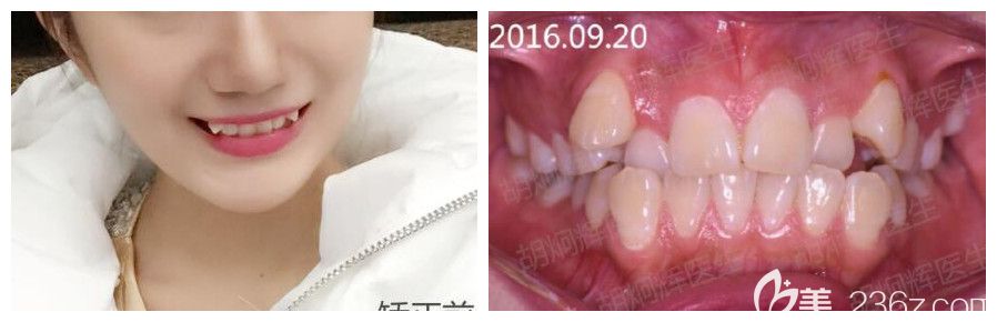 去從重慶牙博士口腔做虎牙矯正前照片 去從重慶牙博士口腔做虎牙矯正前照片