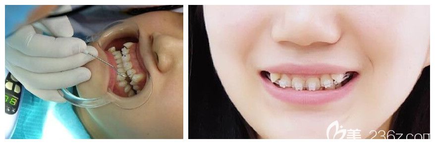 牙博士虎牙矯正帶牙套第1天 牙博士虎牙矯正帶牙套第1天