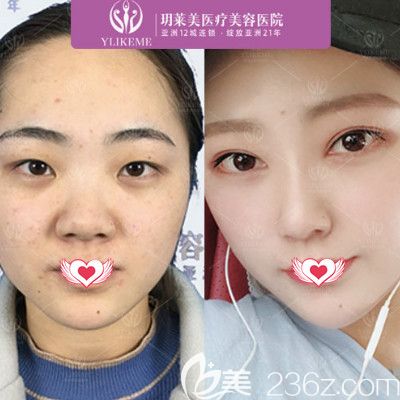 郭海艷醫(yī)生做眼綜合案例