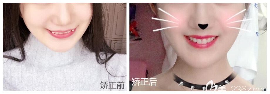 重慶牙博士口腔虎牙矯正前后對(duì)比照公布 重慶牙博士口腔虎牙矯正前后對(duì)比照公布