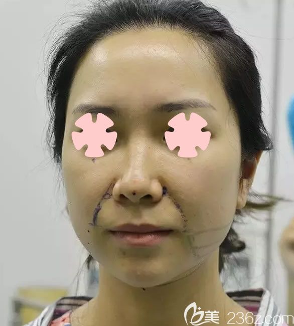 我在南寧美麗焦點(diǎn)做全臉線雕提升前的照片 我在南寧美麗焦點(diǎn)做全臉線雕提升前的照片