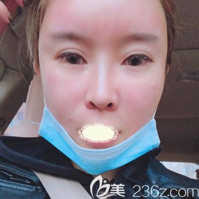 哈爾濱臻美<!--<i data=20240703-sp></i>-->面部自體脂肪填充術(shù)后1天效果展示