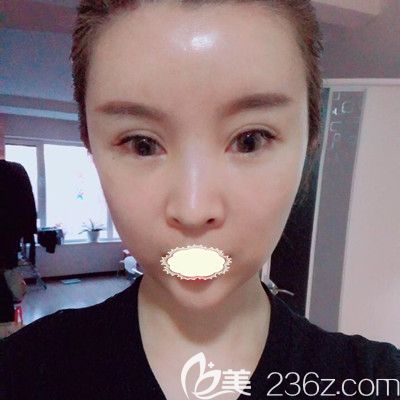 哈爾濱臻美<!--<i data=20240703-sp></i>-->面部自體脂肪填充術(shù)后7天對(duì)比圖