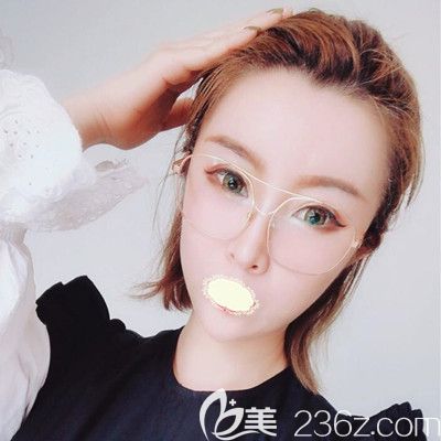 哈爾濱臻美<!--<i data=20240703-sp></i>-->面部自體脂肪填充術(shù)后18天效果圖