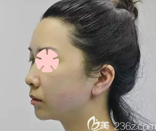 我在南寧美麗焦點(diǎn)整形做全臉埋線提升后 我在南寧美麗焦點(diǎn)整形做全臉埋線提升后