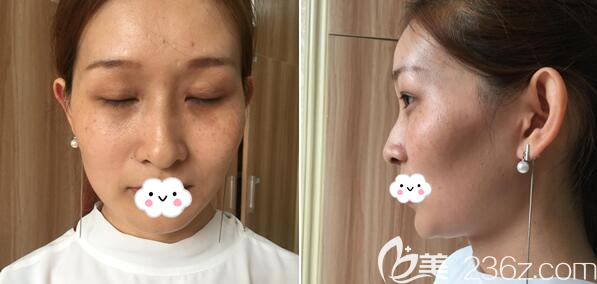 術(shù)前太陽穴臉頰凹陷 術(shù)前太陽穴臉頰凹陷