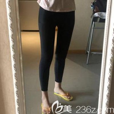 哈爾濱臻美<!--<i data=20240703-sp></i>-->腿部吸脂塑形術(shù)后20天效果照