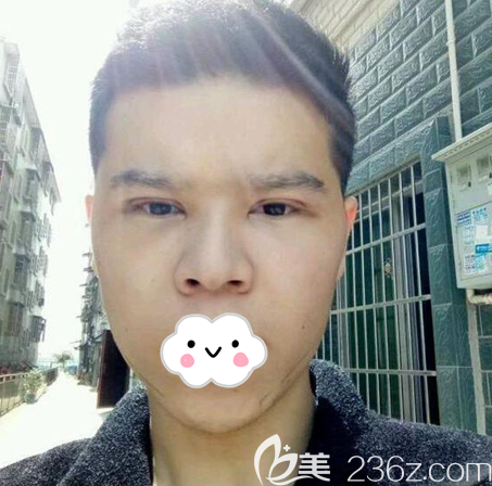 <i data-id='6f25ea73-45be-43f6-8020-50cbfcde0b3a' style='display:none;'></i>文科埋線雙眼皮術(shù)后4天