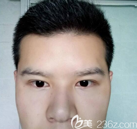 <i data-id='6f25ea73-45be-43f6-8020-50cbfcde0b3a' style='display:none;'></i>埋線雙眼皮術(shù)后一個月