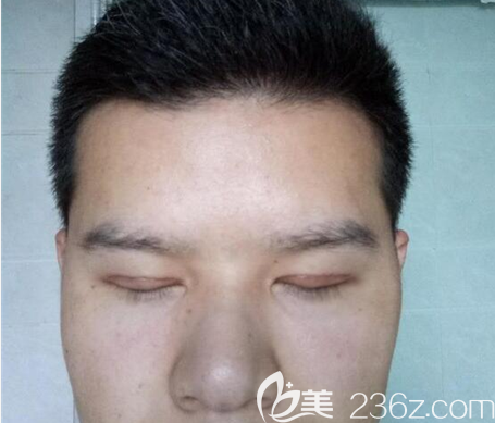 埋線雙眼皮術(shù)后一個月閉眼效果