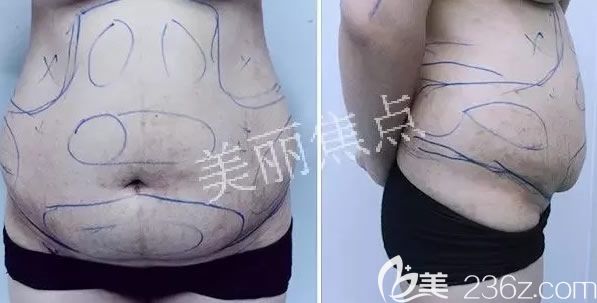 我在南寧美麗焦點(diǎn)整形做腰腹部吸脂術(shù)前設(shè)計(jì)