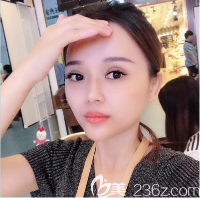 廣州美恩雙眼皮隆鼻術(shù)后恢復照片 廣州美恩雙眼皮隆鼻術(shù)后恢復照片