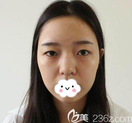 成都軍大整形外科醫(yī)院楊勇術(shù)前照片1