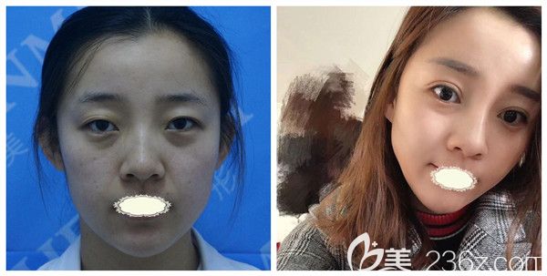 哈爾濱臻美王丹丹全切雙眼皮+開眼角術(shù)后真實(shí)案例對比照