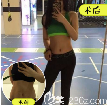 北京壹加壹王珂醫(yī)生腰腹吸脂案例