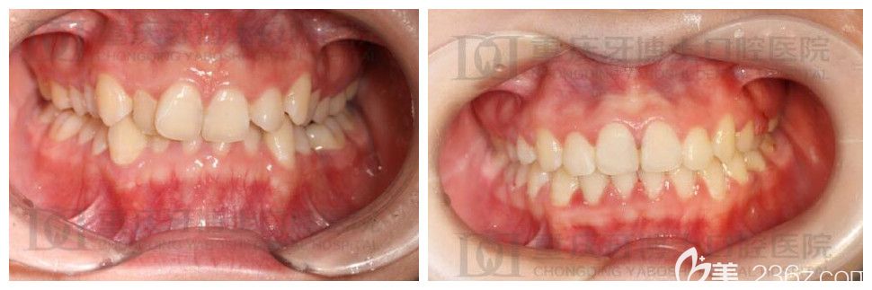 重慶牙博士口腔牙齒矯正怎么樣？劉永桂正畸案例效果公布