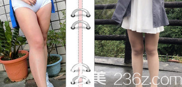 水動(dòng)力吸脂腿部案例二：