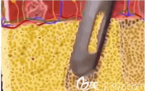 大腿環(huán)吸原理