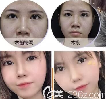 晏傳濤主任眼綜合整形術(shù)后恢復(fù)效果