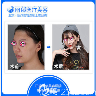 北京米蘭柏羽麗都高超醫(yī)生鼻綜合案例