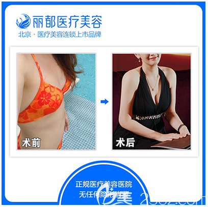 北京米蘭柏羽麗都高海燕醫(yī)生自體脂肪豐胸案例