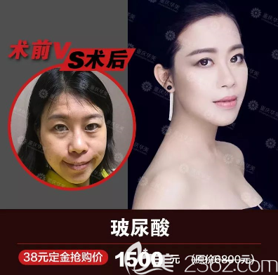 玻尿酸填充面部