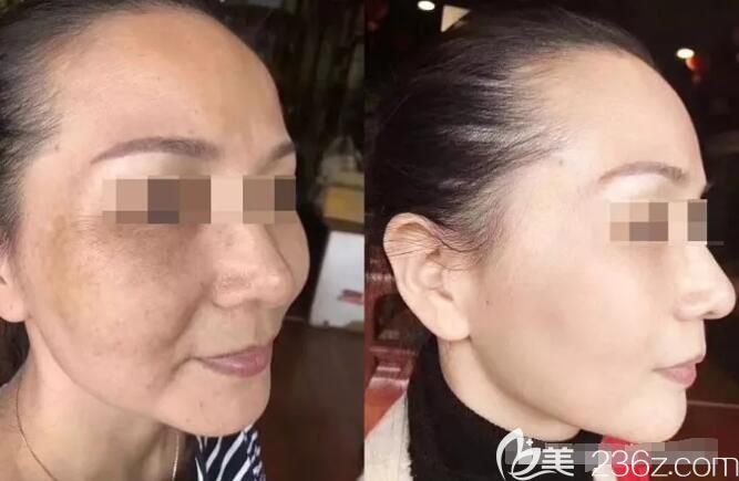 到常熟時代做激光祛斑前后對比案例