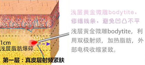 水動(dòng)力吸脂時(shí)候擊碎脂肪的示意圖